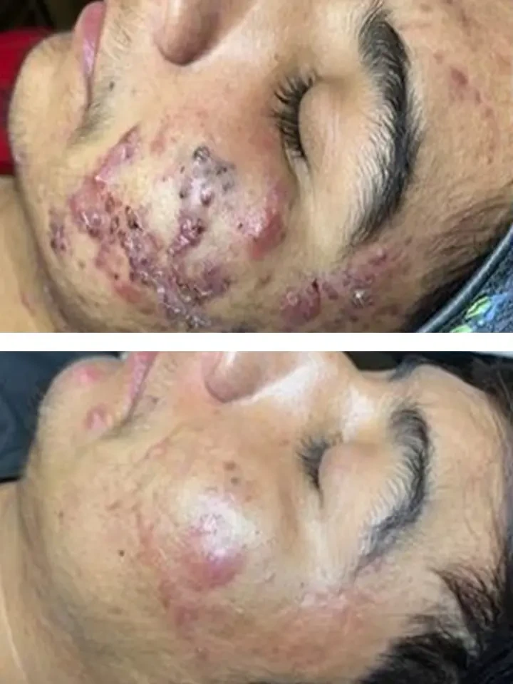 Acne Jump Start treatment result