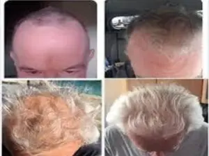 A man with different hair colors and stages of hair loss.