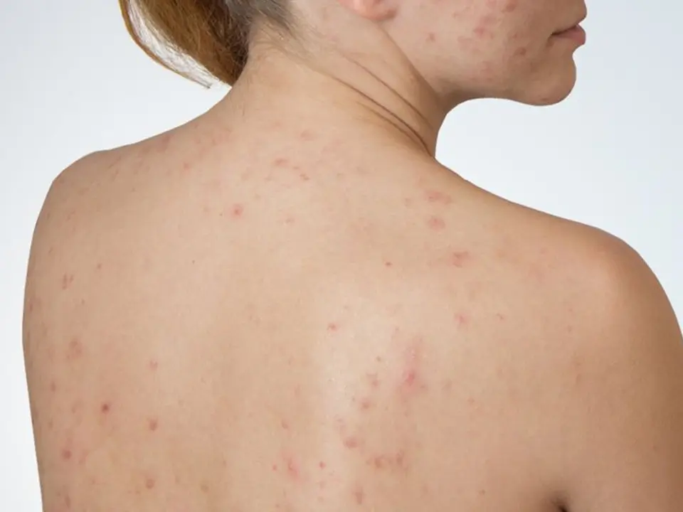 Back Acne Acne Back Facial