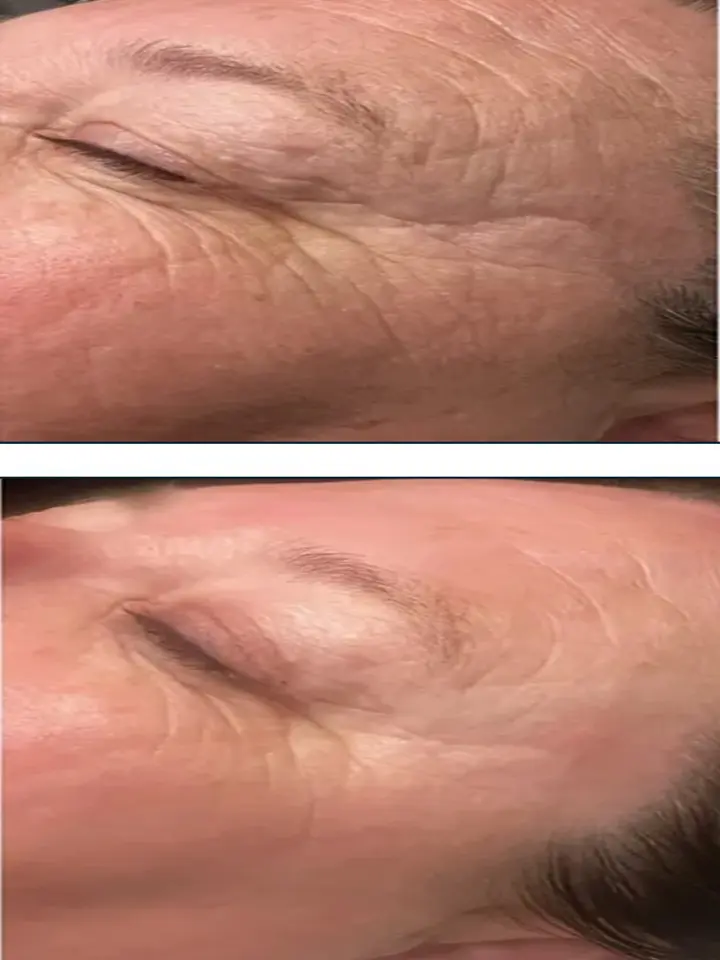 Deep Dermal Peel – no downtime