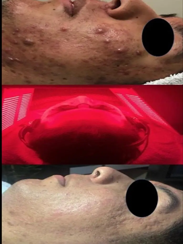 LED Acne Facial A collage of pictures showing different stages of acne.