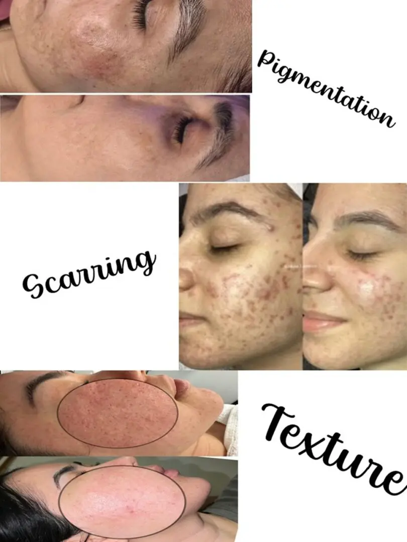 Pigmentation Scarring Texture