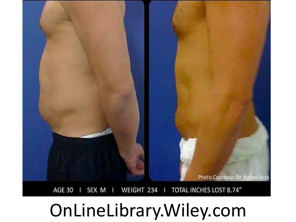Fat Loss LED Fat Loss LED