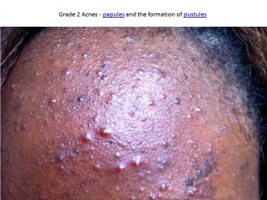 Grade 2 Acne