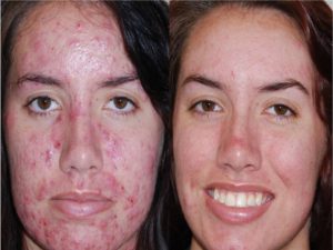 LED Skin Care Spa for Acne