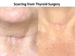 Scarring - thyroid Surgery