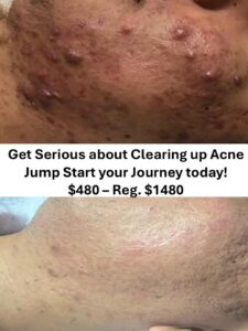 Jump Start Acne Clearning