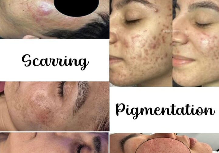 Acne Pigmentaiton Scarring Texture