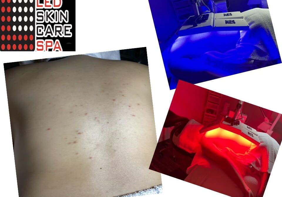 Back Acne an